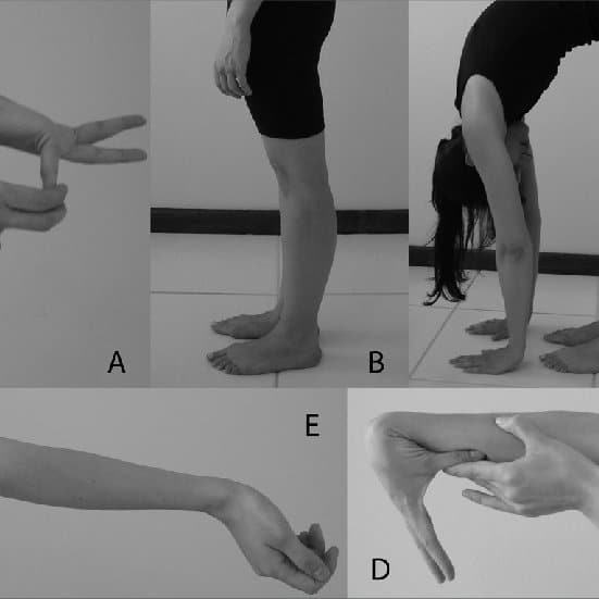 Beighton score for joint laxity examples