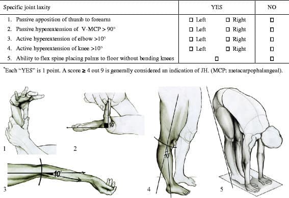 Beighton score for joint laxity